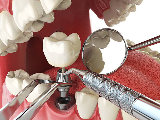 Best Emergency Tooth Extraction in Amesti, CA